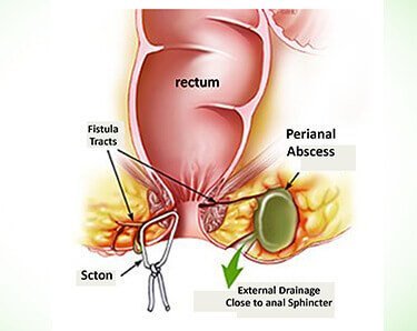 Symptoms of Fistula