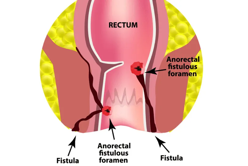 Understanding Fistula