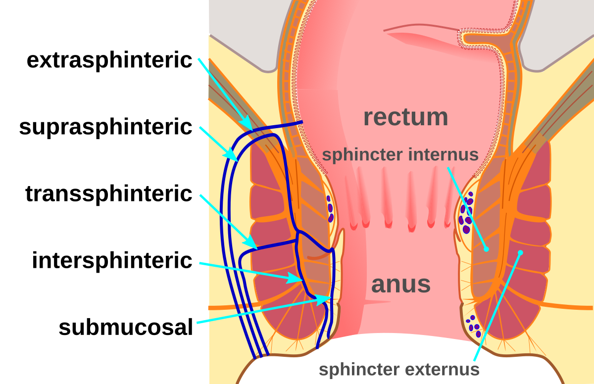 Understanding Fistula