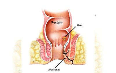 Fistula